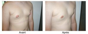 Chirurgie des seins chez l'homme